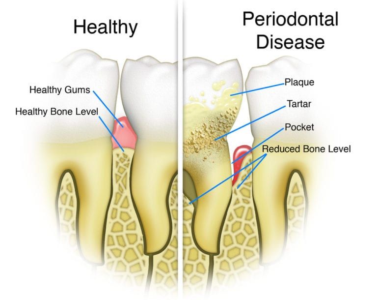 What Is Periodontal Disease Tulsa Precision Dental