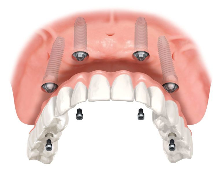 maxillary denture procedure