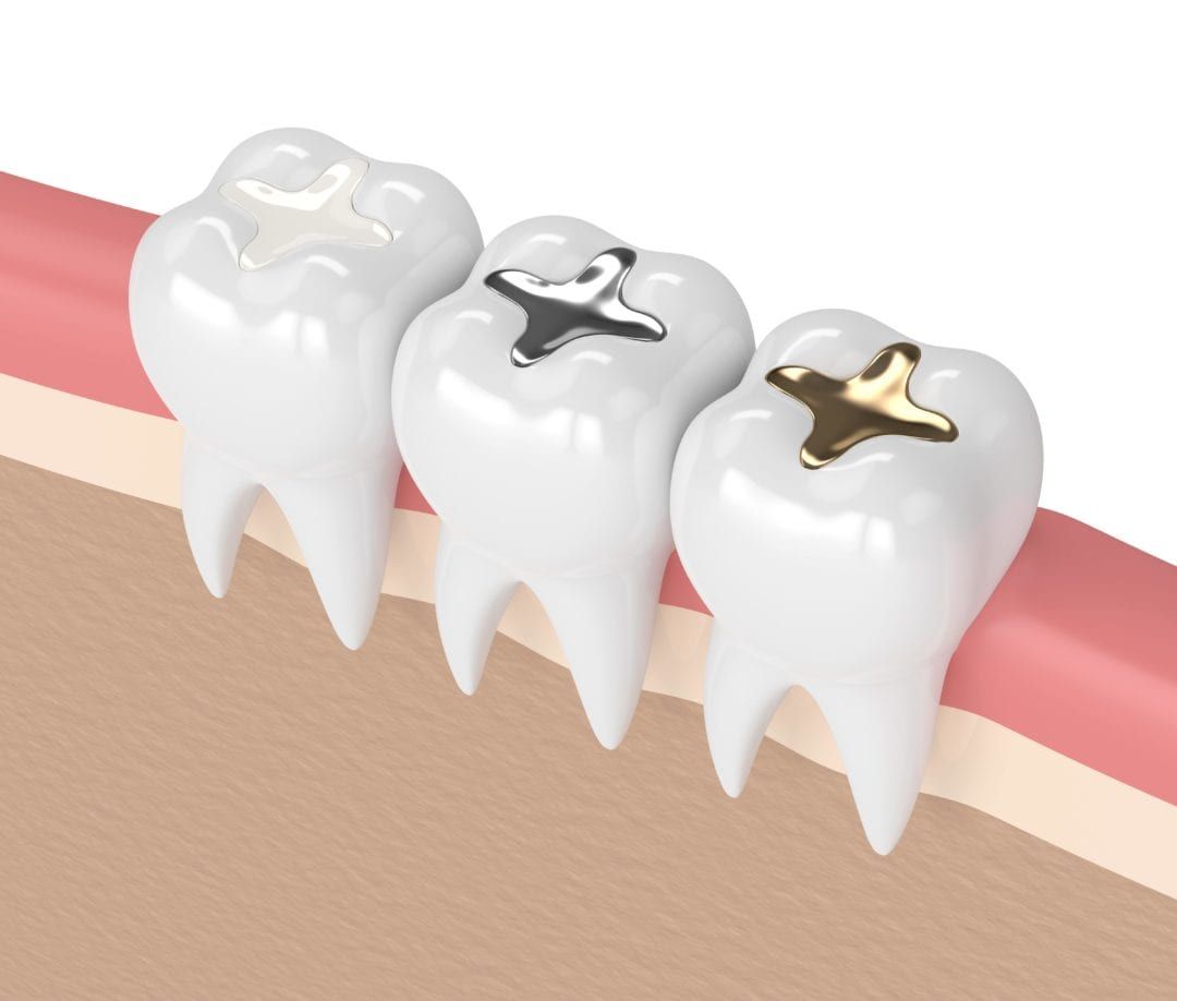 Composite ToothColored Fillings Tulsa Precision Dental