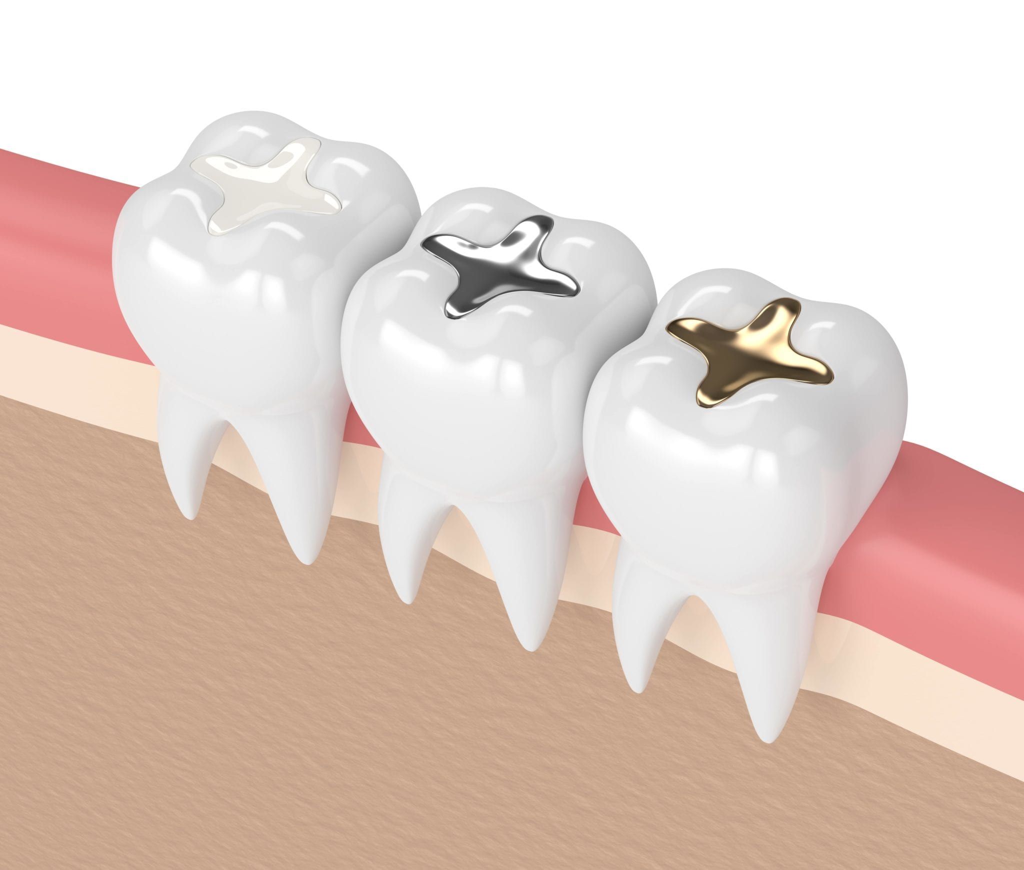 Composite ToothColored Fillings Tulsa Precision Dental