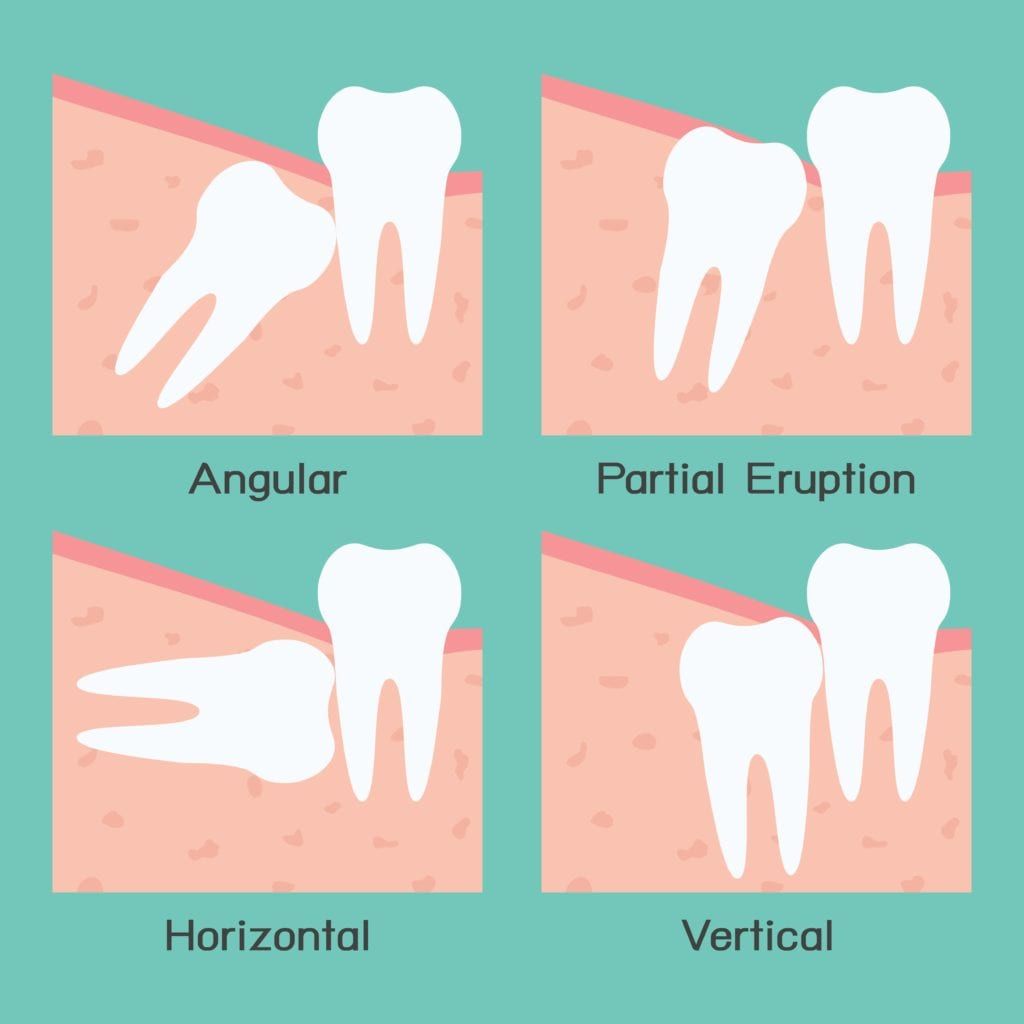Diagram showing the four types of impaction: angular, partial, horizontal, and vertical