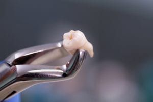 Forceps holding an extracted tooth