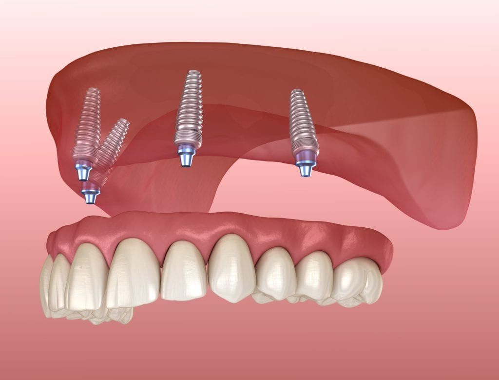 Dental Implants & Implant Fixed Dentures - Tulsa Precision Dental