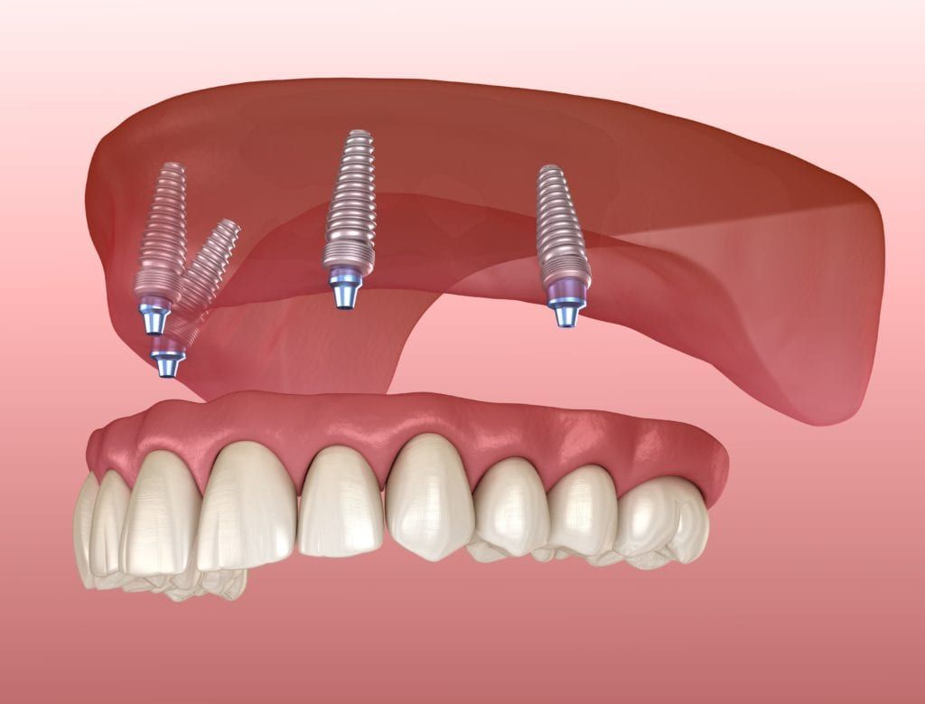 Tips On How To Take Care Of Dental Implants To Ensure Their Longevity   Implant Supported Denture 1024x779 .optimal 