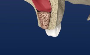 Computerized image of a bone graft