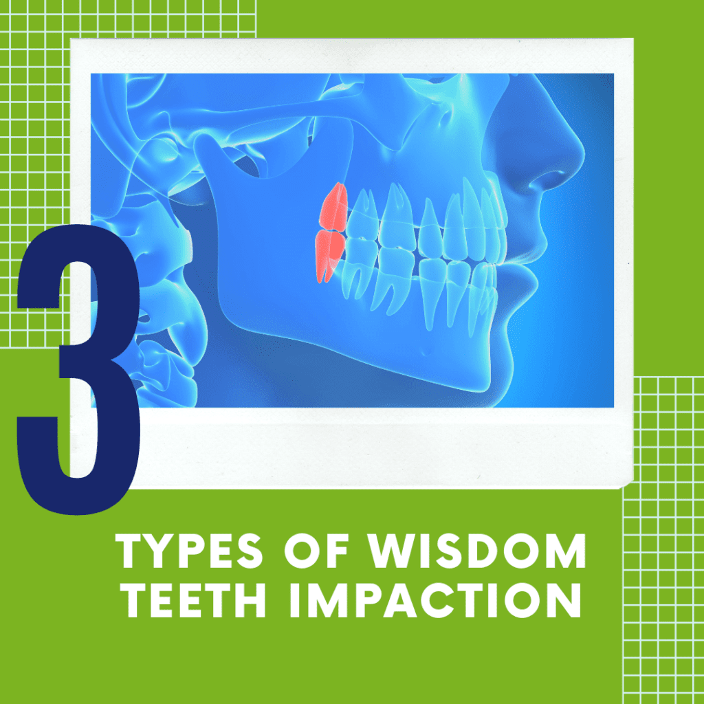 3-types-of-wisdom-teeth-impaction-tulsa-precision-dental