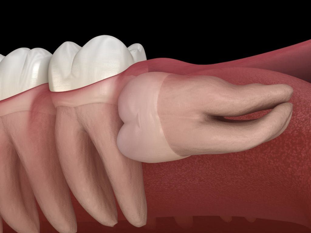 Horizontal impacted wisdom tooth