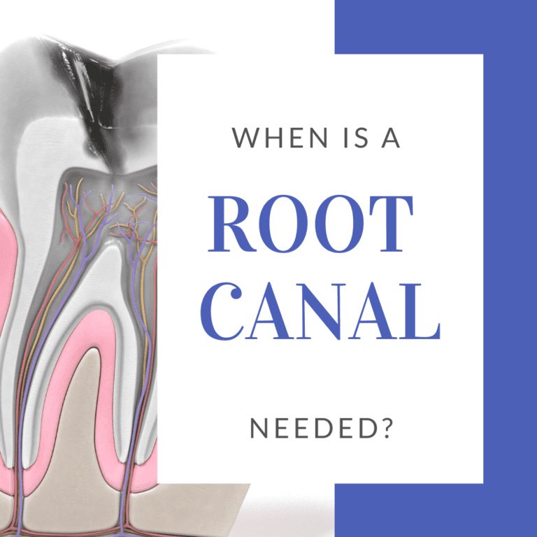 When a Root Canal is Needed?