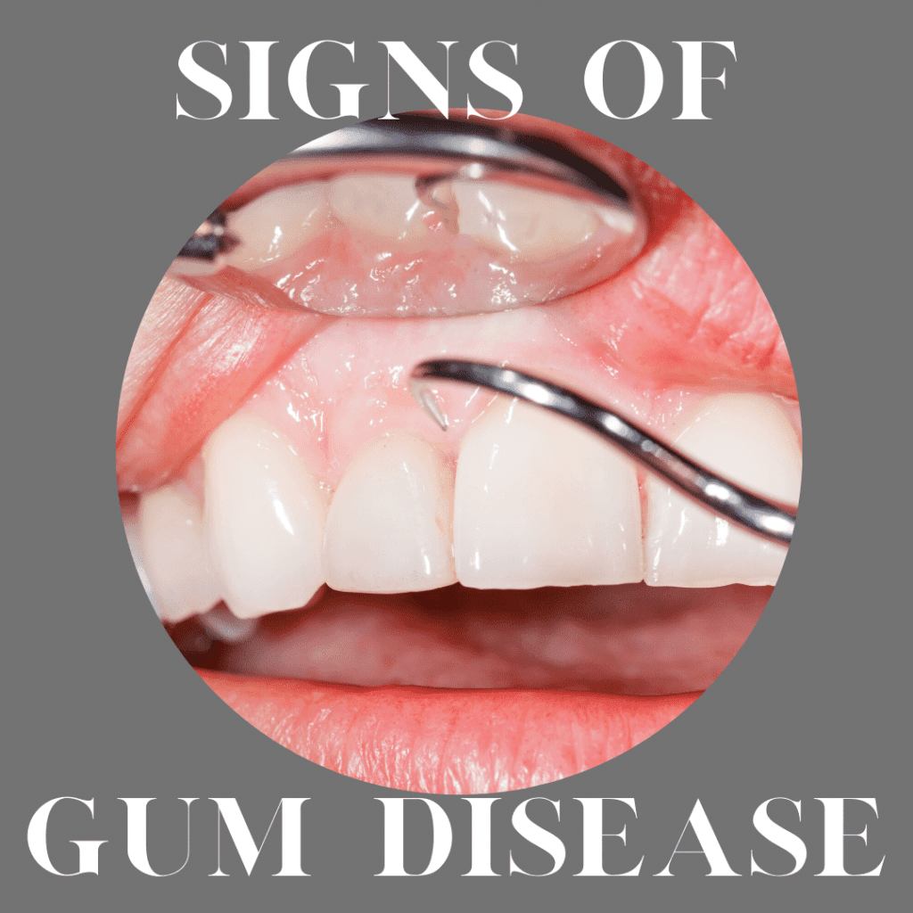 Signs of Gum Disease