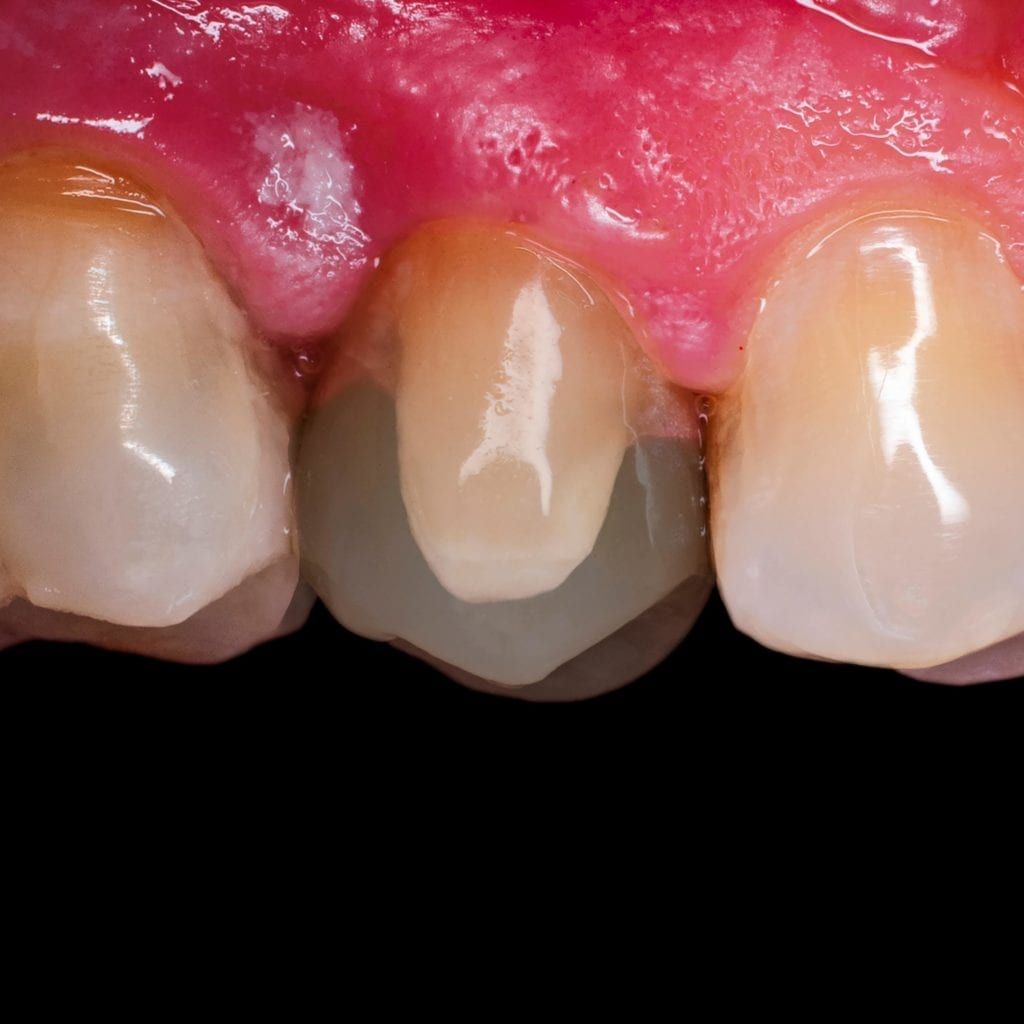 veneer shown over oddly shaped tooth