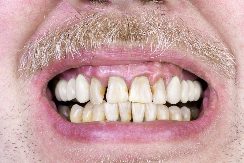 man smiling and showing teeth that have not had proper hygiene
