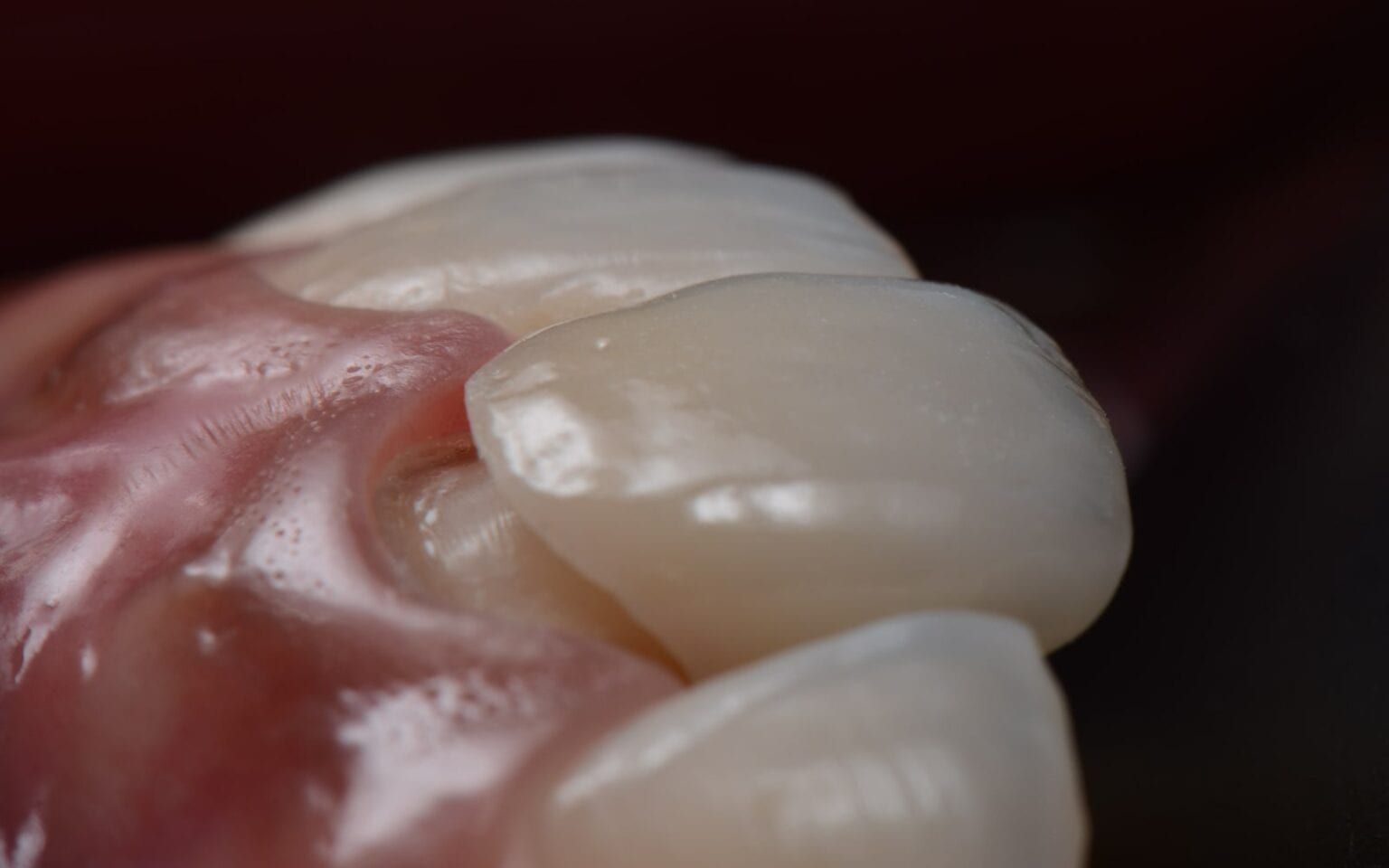 How Orthodontic Bonding Adhesive Can Protect Against Decay