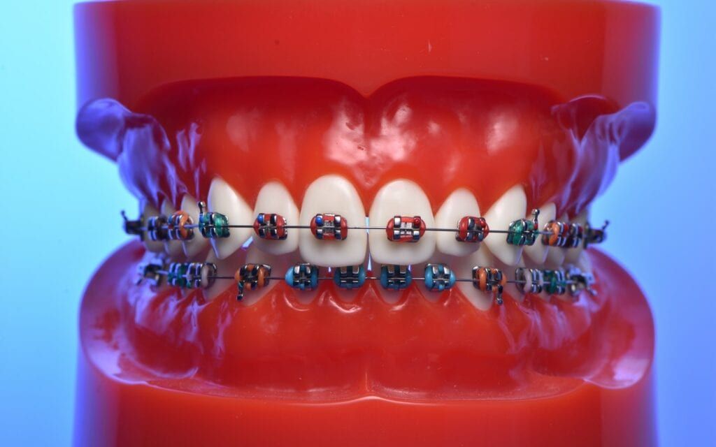 Model of teeth with braces