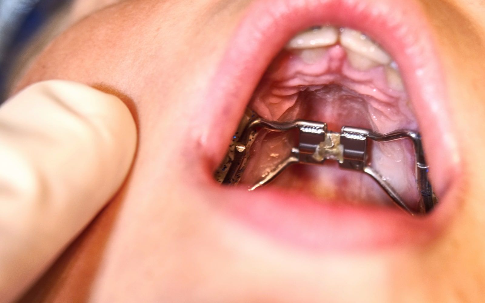 What is The Orthodontic Anchorage Control Technique? Tulsa Precision