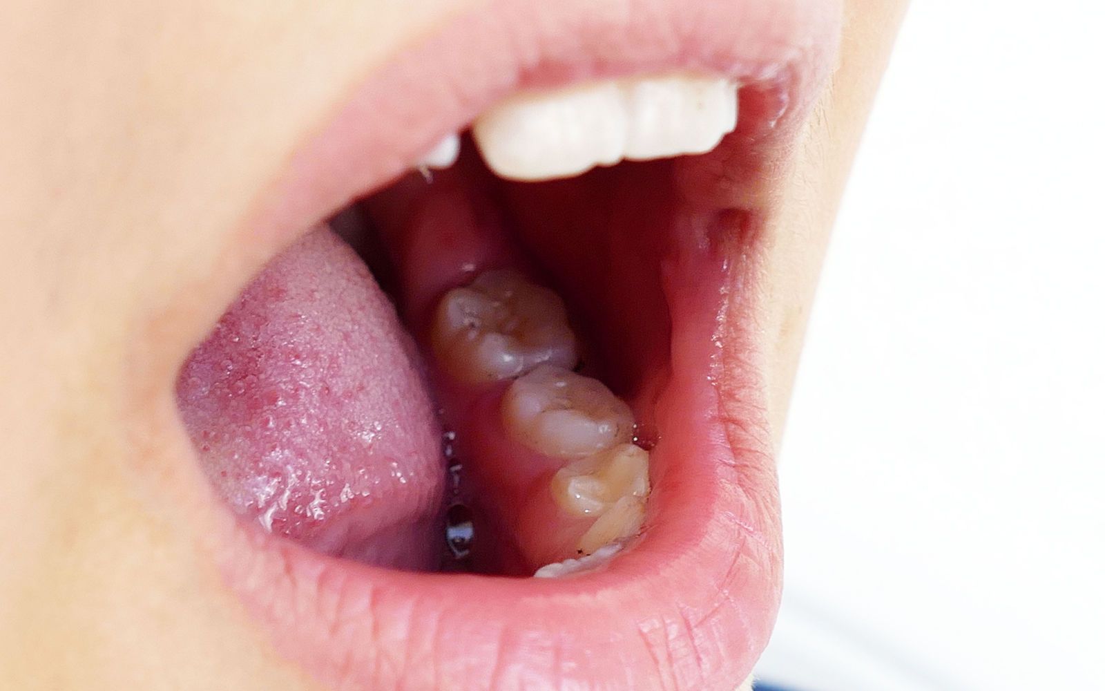 mouth-cancer-bumps-under-tongue